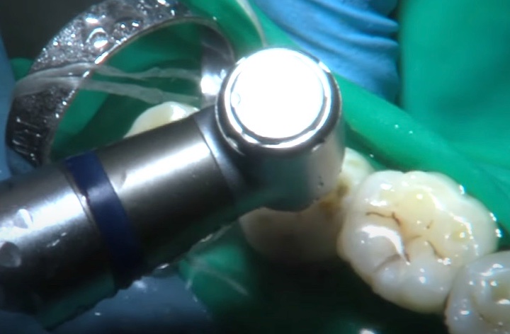 Endodoncia dental en Las Palmas – Clínica Anyma Dental – Avenida de Rafael Cabrera 10