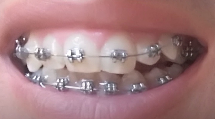 Tratamientos de Ortodoncia y brackets en Las Palmas Clínica Anyma Dental – Avenida de Rafael Cabrera 10